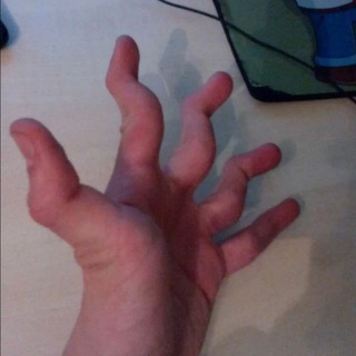 Ревматоидный артрит курильщика