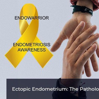 Про эндометриоз