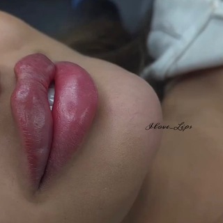 Косметолог • Увеличение губ • ilove_lips