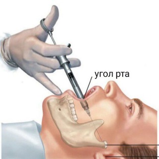 Мандибулярка💉