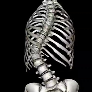 Всё о сколиозе от эксперта Ольги Буровой