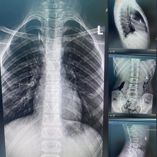 Лфк: Сколиоз, кифоз, вальгус